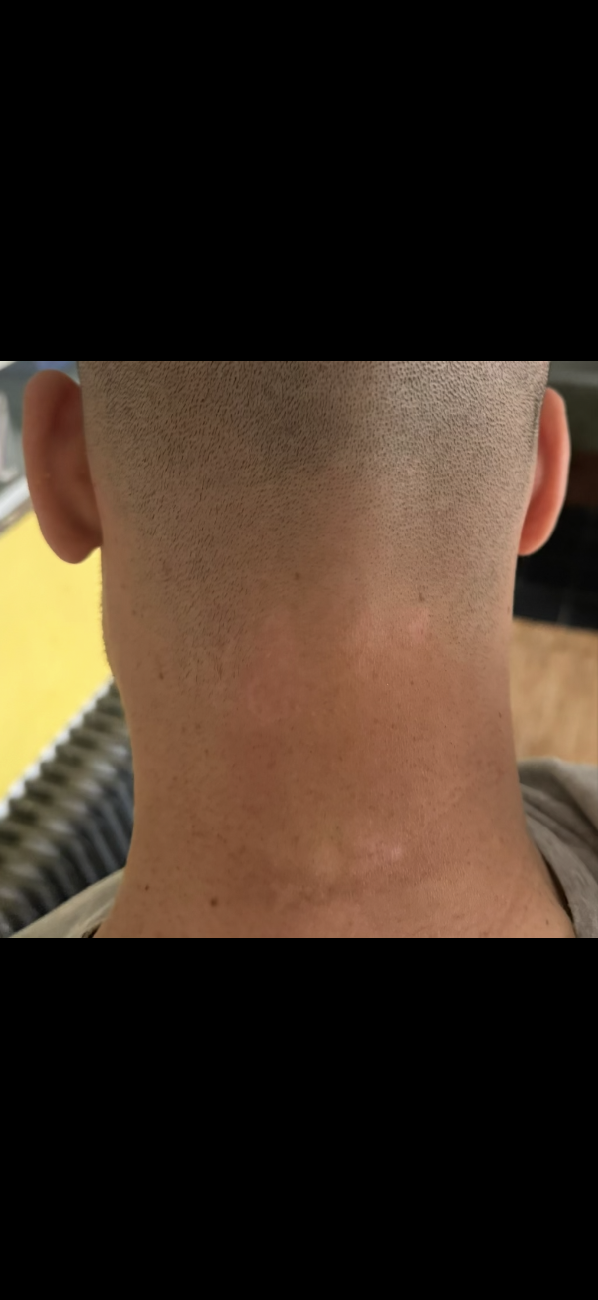 Filip vitiligo krk