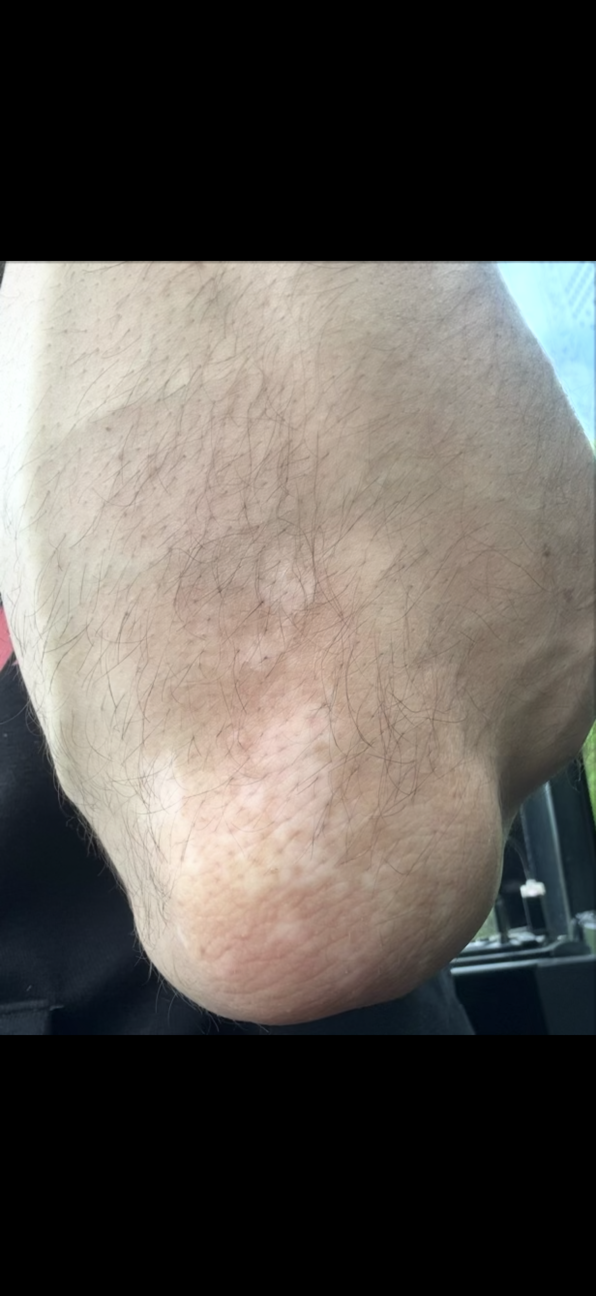 Filip vitiligo lakeť