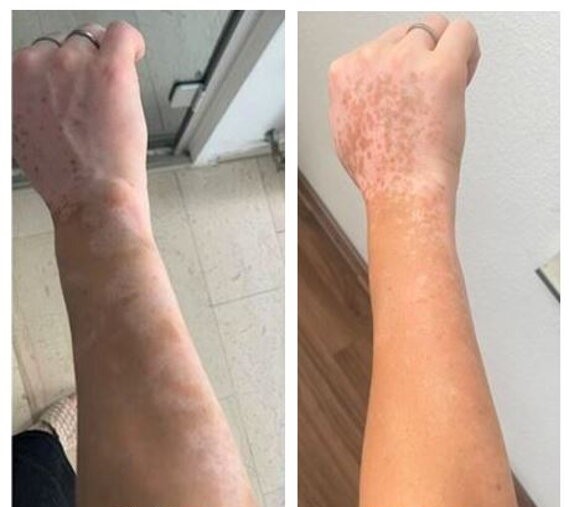 Vitiligo na ruke pred liečbou a po liečbe UVB svetlom