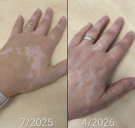 vitiligo na rukách pred a po