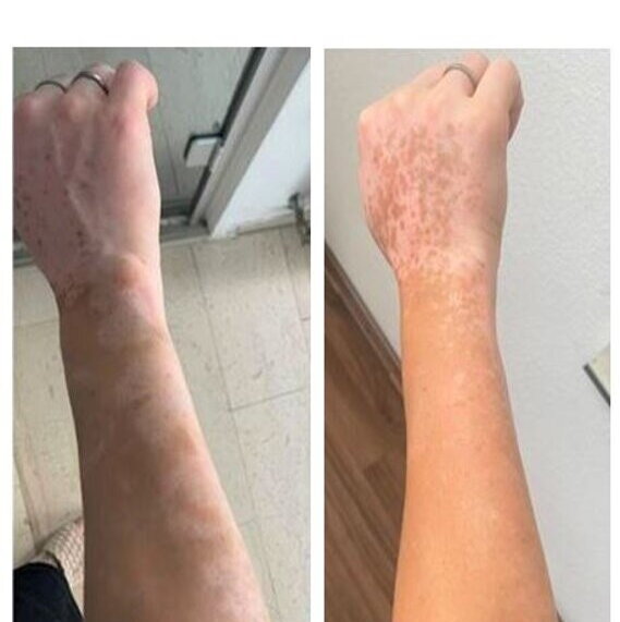 vitiligo repigmentace 