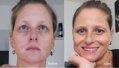 Vitiligo Štartovací Set (200ml Gel + 60 Tabliet + Zanderm korektor)