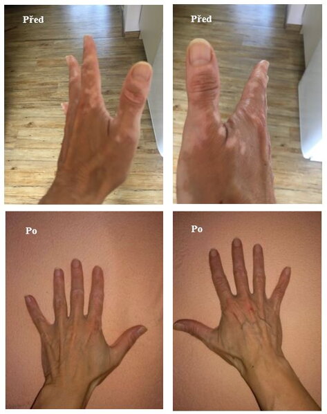 Vitiligo na rukách pred a po