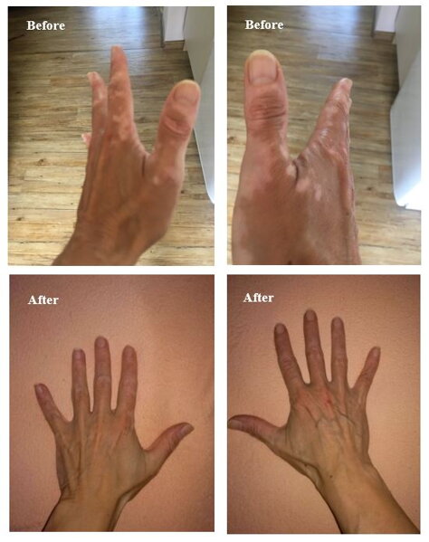 Aktívne alebo stabilné vitiligo? Ako rozpoznať, že sa šíri, a čo to mení v liečbe