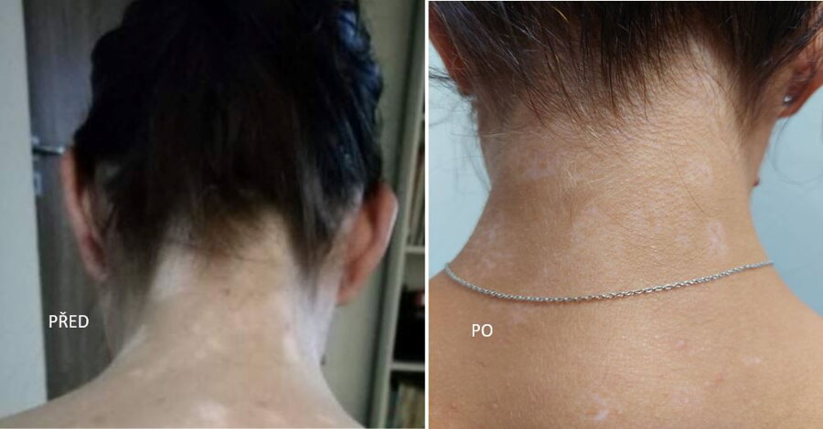 Vitiligo na zátylku pred a po – Andy H., VitiligoShop