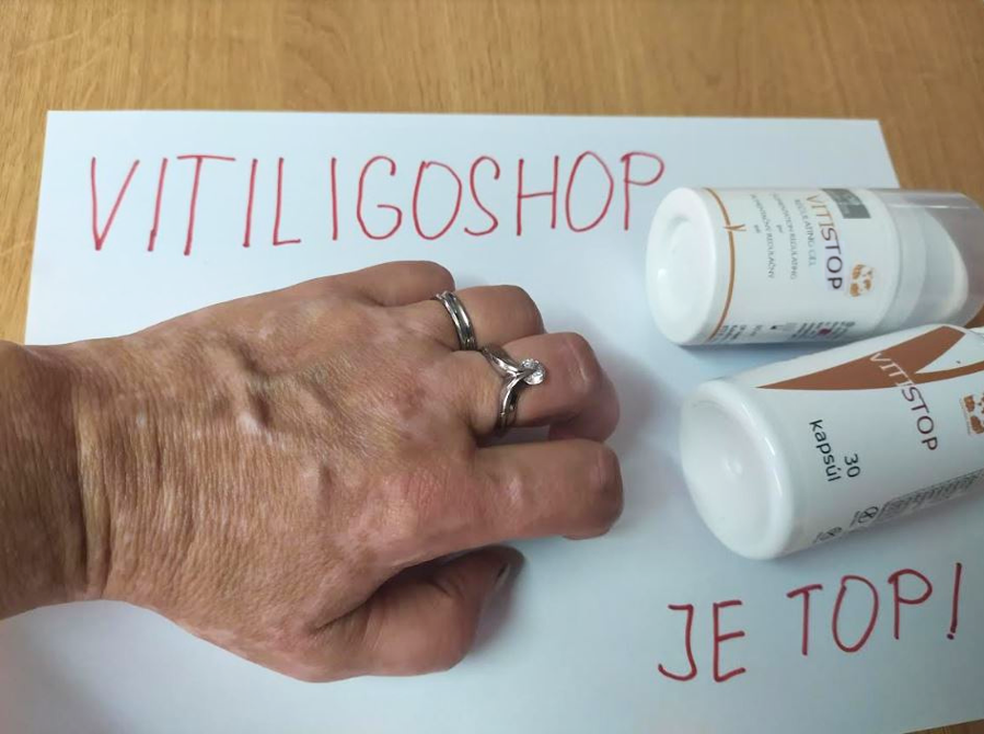 Vitiligo na ruke – Jana V., zákazníčka VitiligoShop