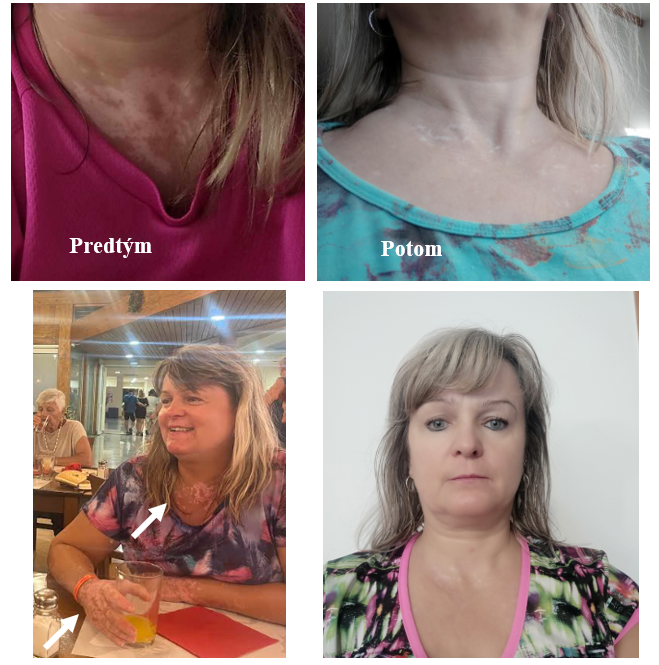 Vitiligo na krku a dekolte – Jana V., zákazníčka VitiligoShop