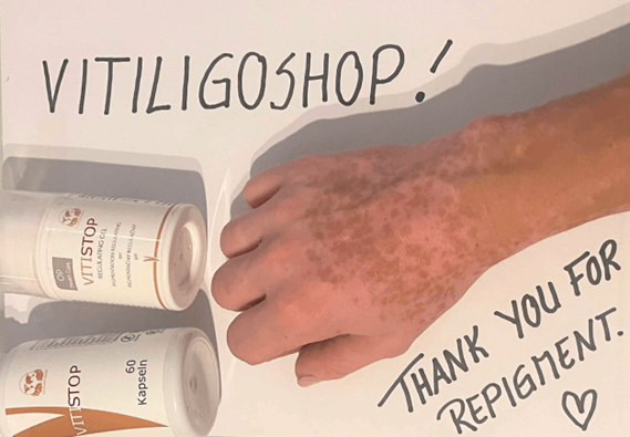 Vitiligo na ruke a prstoch – Julia, zákazníčka VitiligoShop