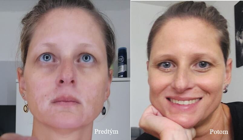 Vitiligo na tvári pred a po – Petra B., zákazníčka VitiligoShop